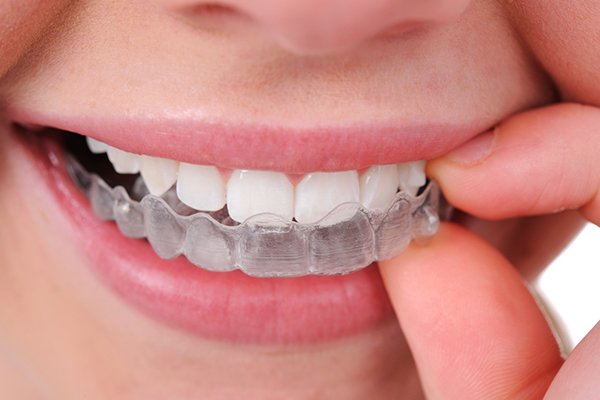 افضل دكتور تقويم شفاف ببريده